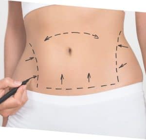 Rehabilitación en Abdominoplastía y Liposucción - Técnica Fibrosis Zero