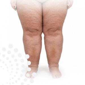 Curso lipedema online y semipresencial