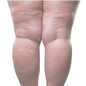 Manejo Conservador del Lipedema Med Academy