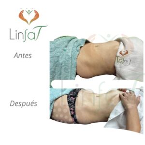 Drenaje Linfático Metodo Linfat
