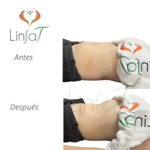 Drenaje Linfático Metodo Linfat