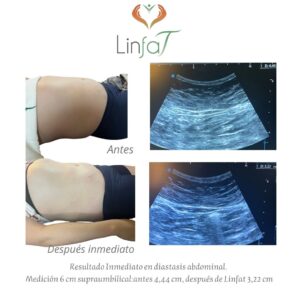 Drenaje Linfático Metodo Linfat