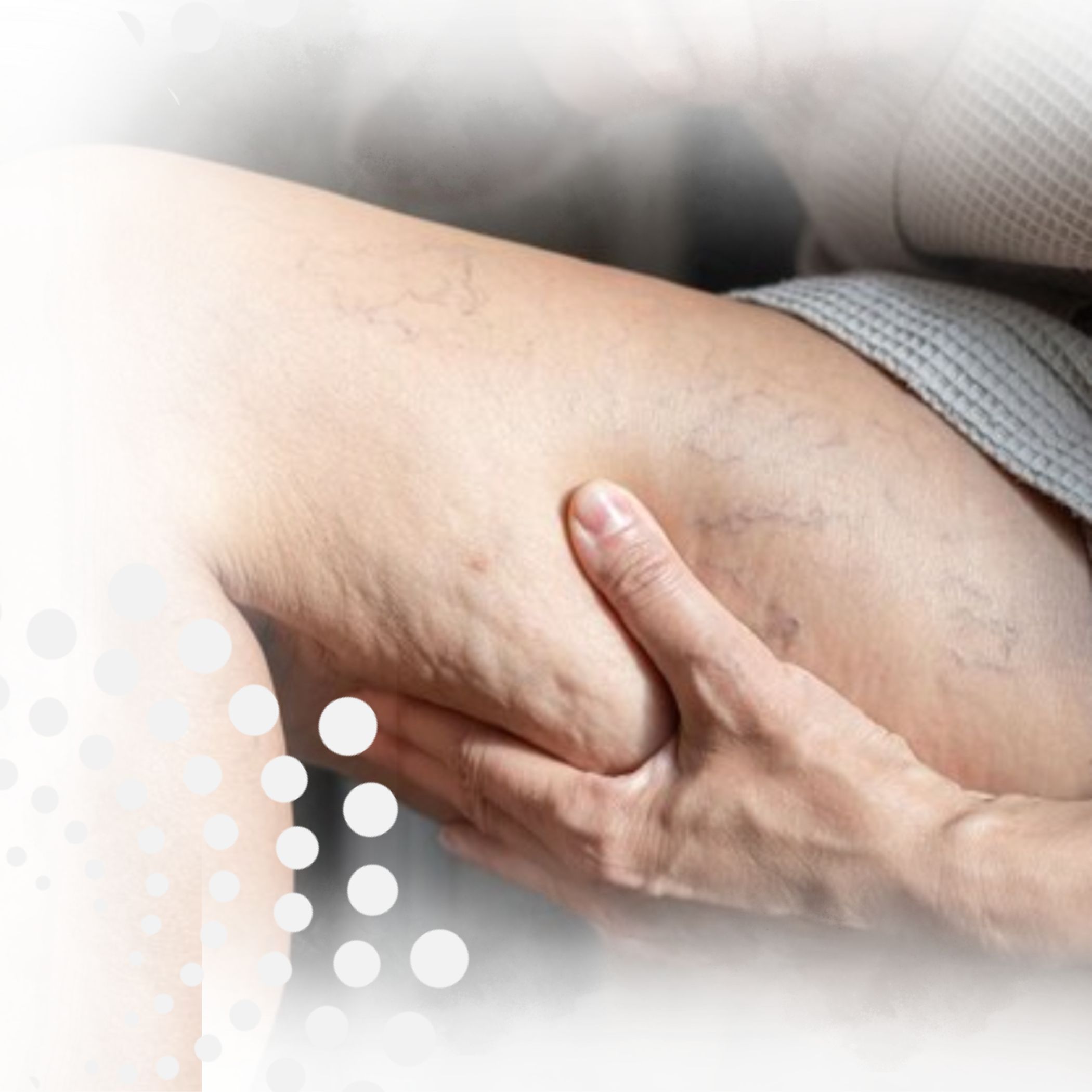 Curso lipedema en Chile