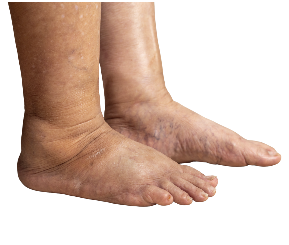 Congreso Linfedema y lipedema